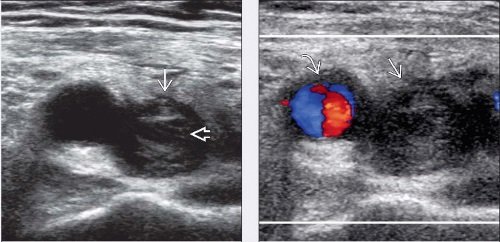 Θρόμβωση υπέρηχοι κατ οίκον