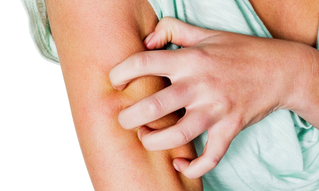 You are currently viewing Ποια η σχέση της ψωρίασης και της ιδεοψυχαναγκαστικής διαταραχής