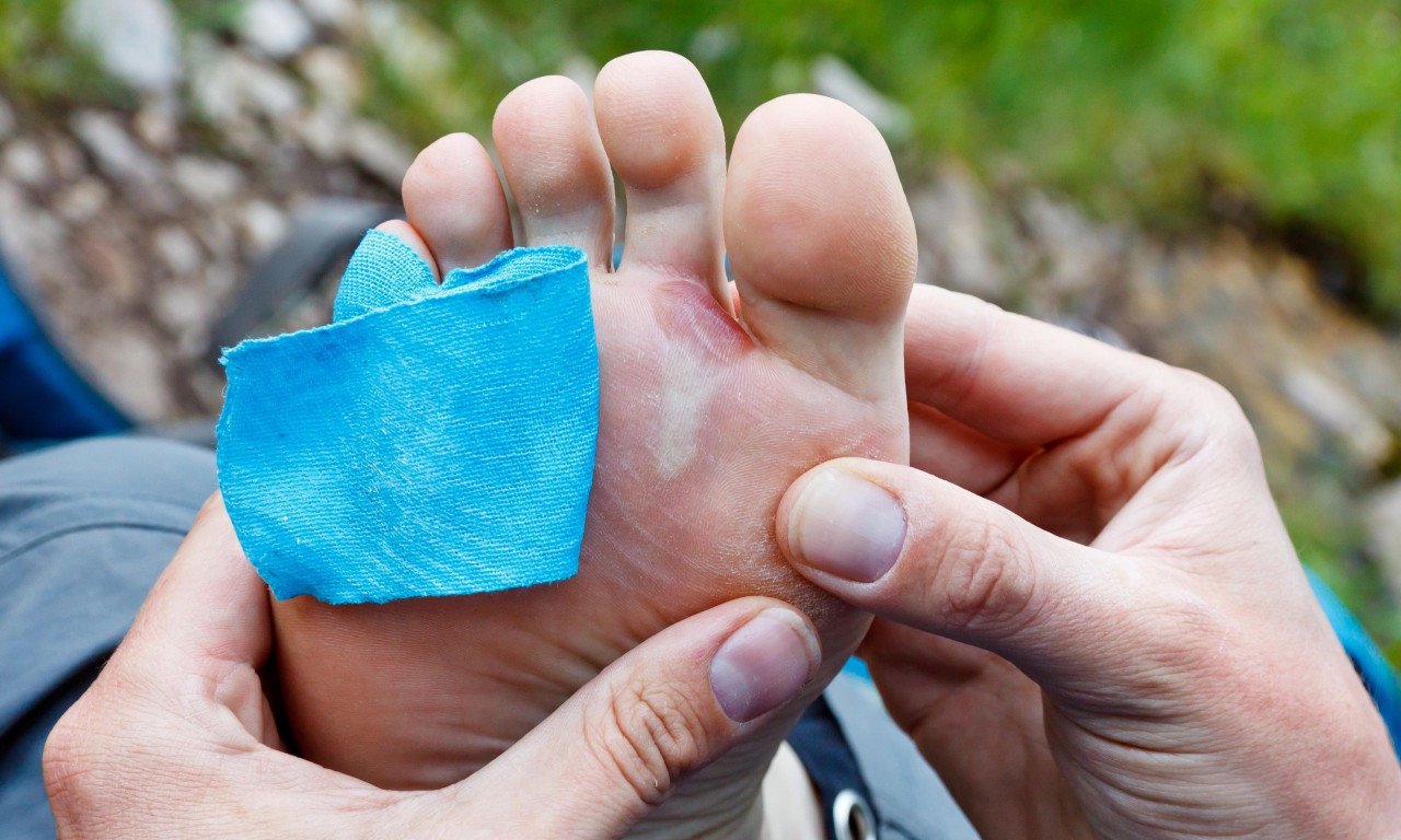 You are currently viewing Τι κάνουμε για τη φουσκάλα στο πόδι πριν και αφότου σκάσει