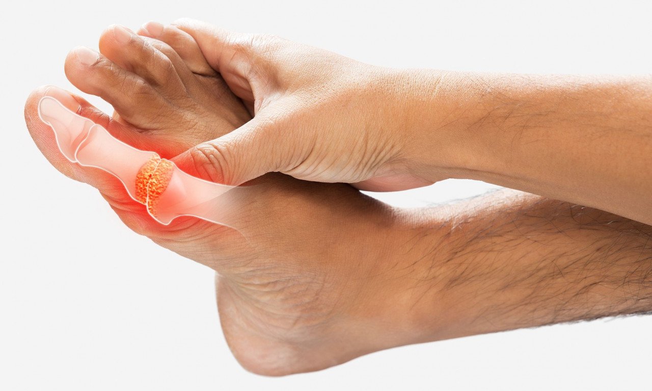 Read more about the article Ανεβασμένο ουρικό οξύ: Με ποια διατροφή θα το αντιμετωπίσετε