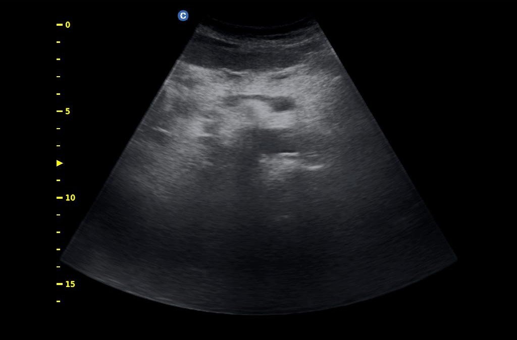 υπέρηχος άνω κοιλίας κατ' οίκον