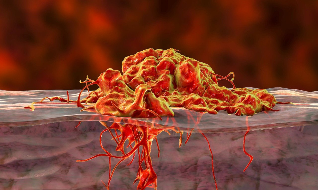 You are currently viewing Καρκίνος πνεύμονα και εντέρου: Ο κοινός παράγοντας κινδύνου