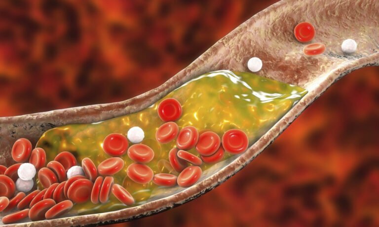 Read more about the article Τι είναι η αθηροσκληρωτική καρδιοπάθεια; Ποιο ρευματικό νόσημα αυξάνει τον κίνδυνο;
