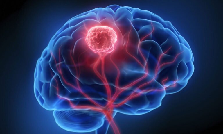 Read more about the article Όγκος εγκεφάλου: Από τα συμπτώματα έως τη θεραπεία