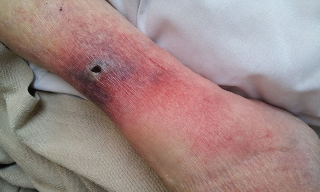 You are currently viewing Λεμφαγγειίτιδα: Τι προκαλεί, πώς αντιμετωπίζεται, πότε αυξάνει τον κίνδυνο σήψης