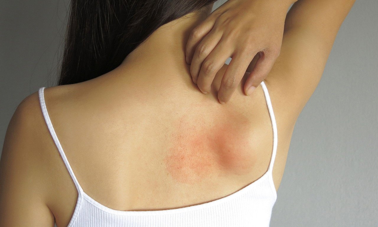 You are currently viewing Γιατί δεν πρέπει να ξύνετε ένα εξάνθημα με φαγούρα