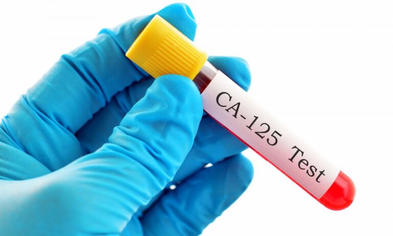 Read more about the article Μπορεί η γενική αίματος να «δείξει» καρκίνο;