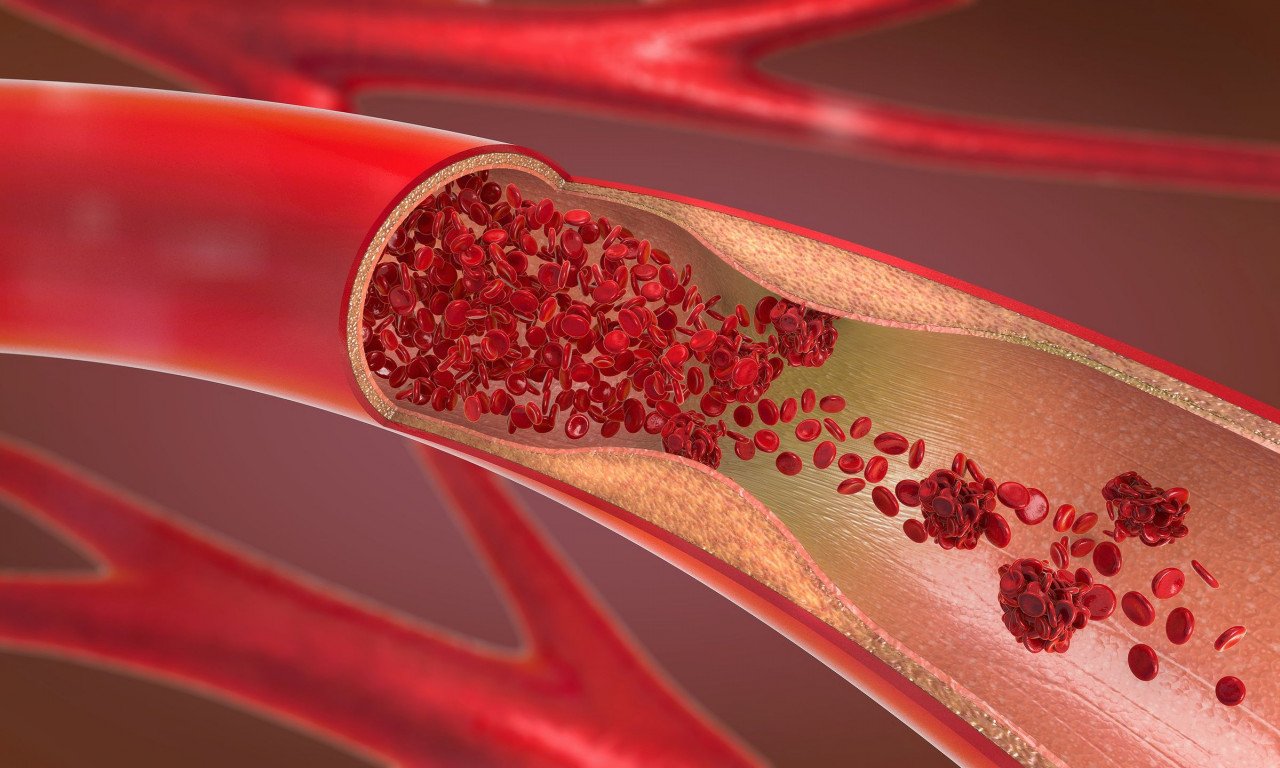 You are currently viewing Αθηροσκλήρωση: Ποιες τροφές προλαμβάνουν τον σχηματισμό πλάκας στις αρτηρίες