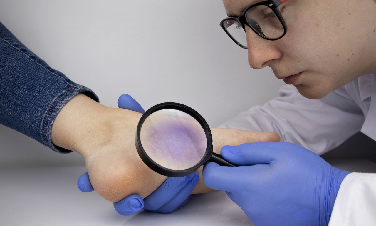 You are currently viewing Γιατί έχετε πρήξιμο στα πόδια – Τα 5 σημάδια ότι είναι σοβαρό