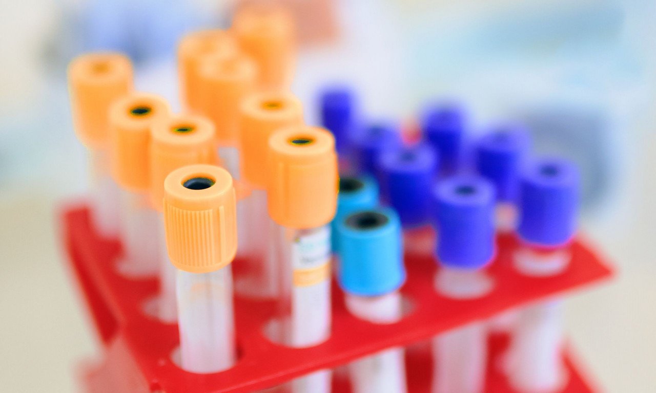 You are currently viewing Ποιοι καρκίνοι θα ανιχνεύονται στο αίμα έως και 3 χρόνια πριν τη διάγνωση