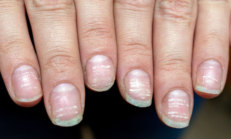 Read more about the article 4 λόγοι που έχετε λευκά σημάδια στα νύχια