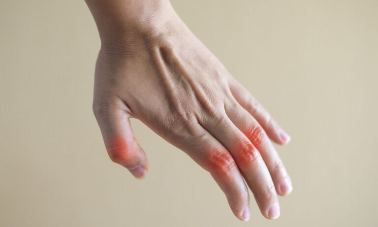 Read more about the article Ρευματοειδής αρθρίτιδα: Γιατί και πού έχουν εκτοξευτεί τα ποσοστά, τι ισχύει για τη θνησιμότητα