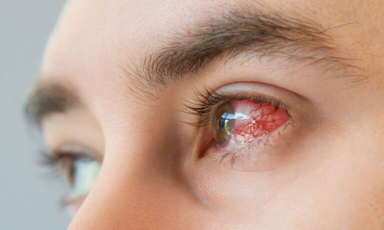 Read more about the article 7 παράσιτα που μολύνουν τα μάτια – Συμπτώματα και αντιμετώπιση
