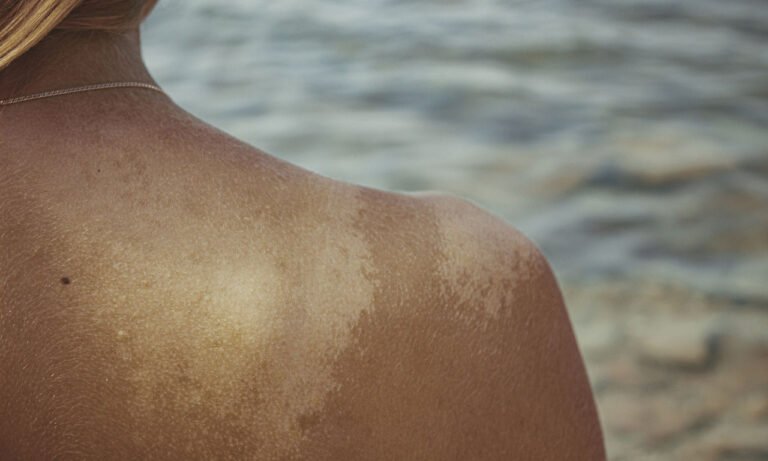 Read more about the article Ψωρίαση: Τα οφέλη και οι κίνδυνοι από την έκθεση στον ήλιο