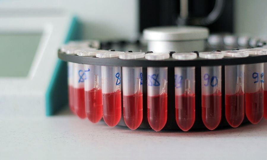 You are currently viewing Έγκαιρη ανίχνευση λευχαιμίας: Σωστή ερμηνεία 5 συμπτωμάτων καρκίνου στο αίμα