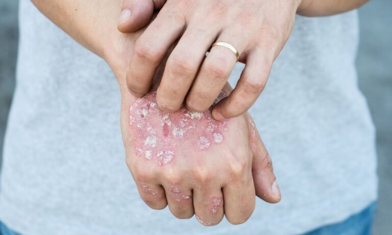 Read more about the article Βιταμίνη D και ψωρίαση: Ένας φυσικός σύμμαχος για το δέρμα