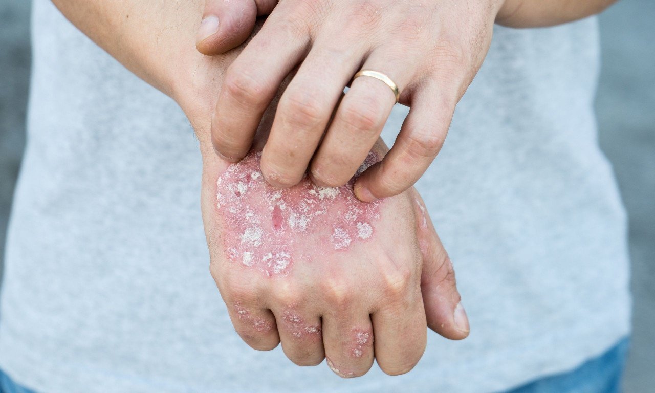 You are currently viewing Βιταμίνη D και ψωρίαση: Ένας φυσικός σύμμαχος για το δέρμα