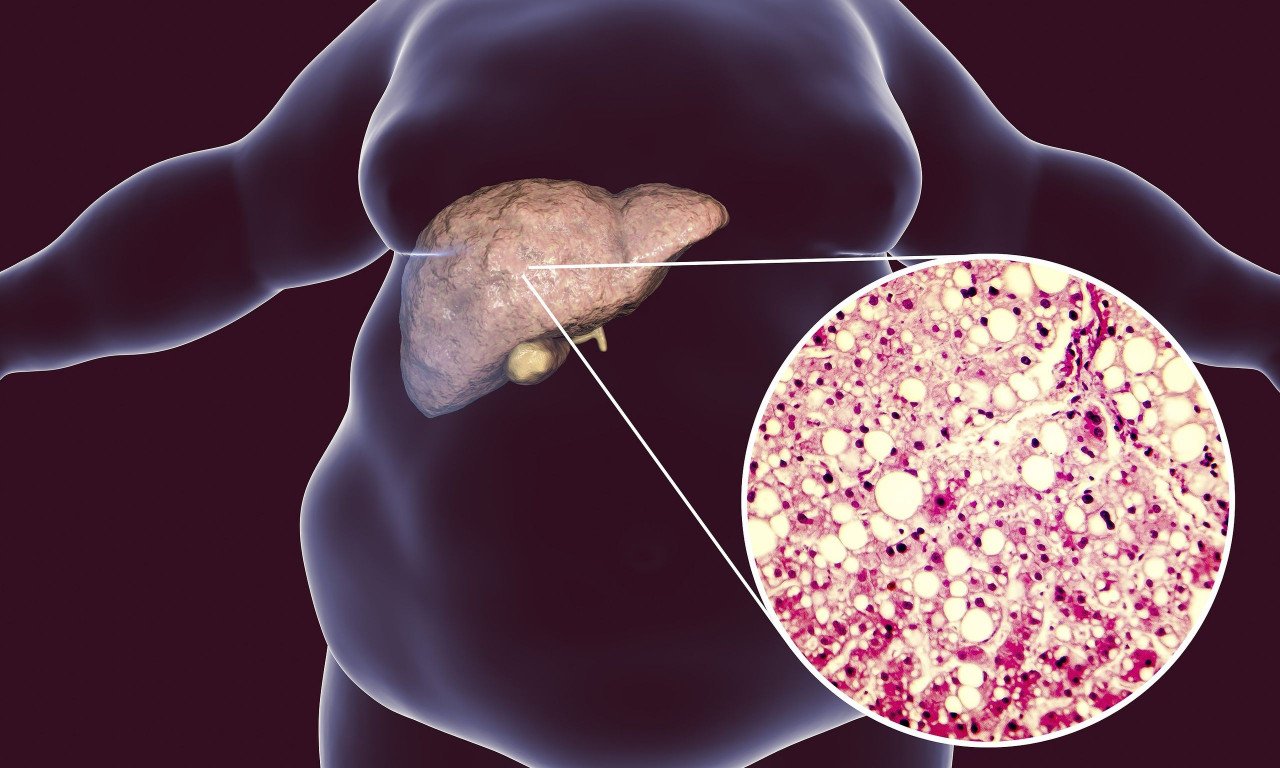 You are currently viewing Λίπος στο συκώτι: Crash test για τις πιο δημοφιλείς δίαιτες – Ποιες το μειώνουν