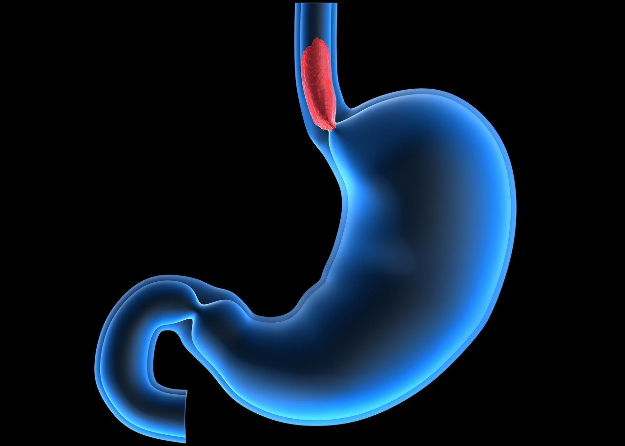 You are currently viewing Οισοφάγος Barrett: Τι προκαλεί τον θανατηφόρο καρκίνο του οισοφάγου