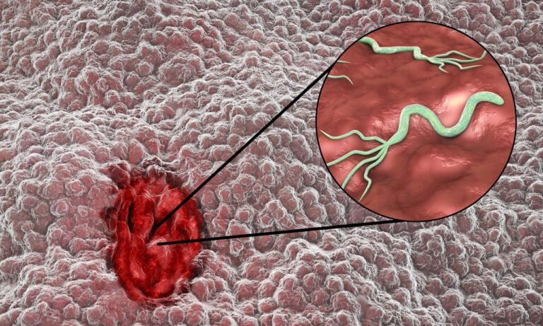 Read more about the article Καρκίνος στομάχου: Τα βακτήρια που ευθύνονται για το 75% των περιπτώσεων