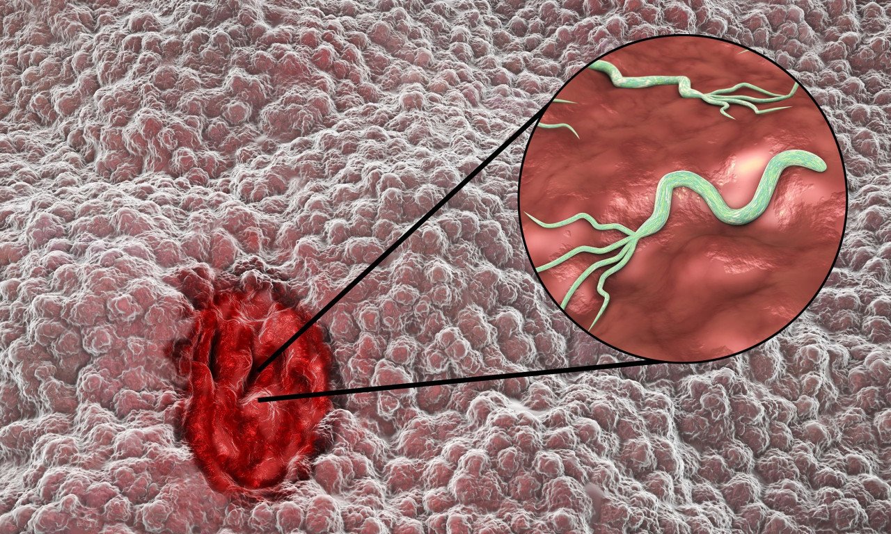 You are currently viewing Καρκίνος στομάχου: Τα βακτήρια που ευθύνονται για το 75% των περιπτώσεων
