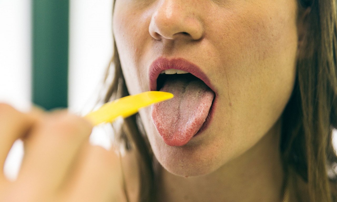 You are currently viewing Πολλαπλό μυέλωμα: Το σημάδι στη γλώσσα που «δείχνει» τον αιματολογικό καρκίνο