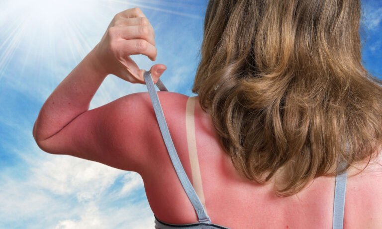 Read more about the article 5 τροφές που βοηθούν στην επούλωση του εγκαύματος από τον ήλιο