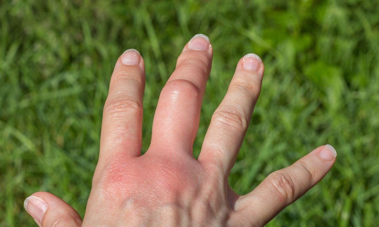 You are currently viewing Πρήζονται τα χέρια και τα πόδια σας το καλοκαίρι; Αιτίες και αντιμετώπιση