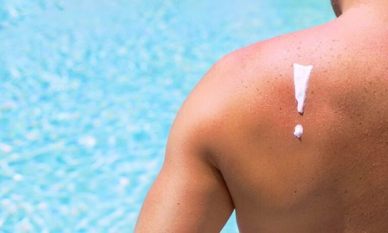 Read more about the article Πώς να αποφύγουμε εγκαύματα και τσιμπήματα το καλοκαίρι