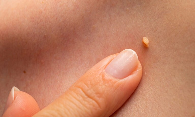 Read more about the article HPV: Mυρμηγκιές το καλοκαίρι –  5 μύθοι γύρω από τα συμπτώματα