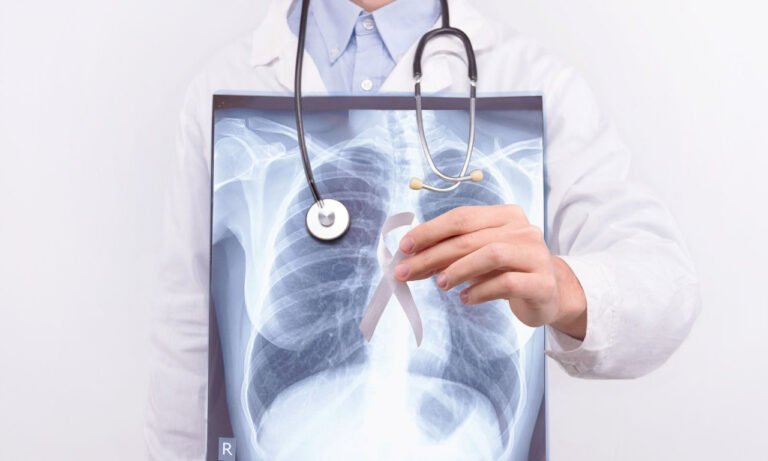 Read more about the article Καρκίνος πνεύμονα: Καινοτόμος ανοσοθεραπεία με ελληνική σφραγίδα