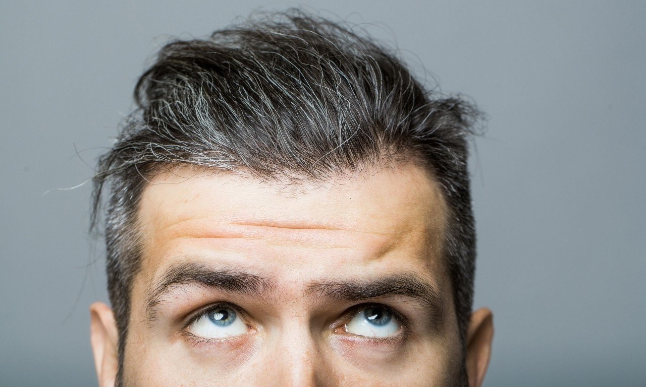 You are currently viewing Πιτυρίδα φρυδιών: Τι την προκαλεί και πώς θα απαλλαγείτε