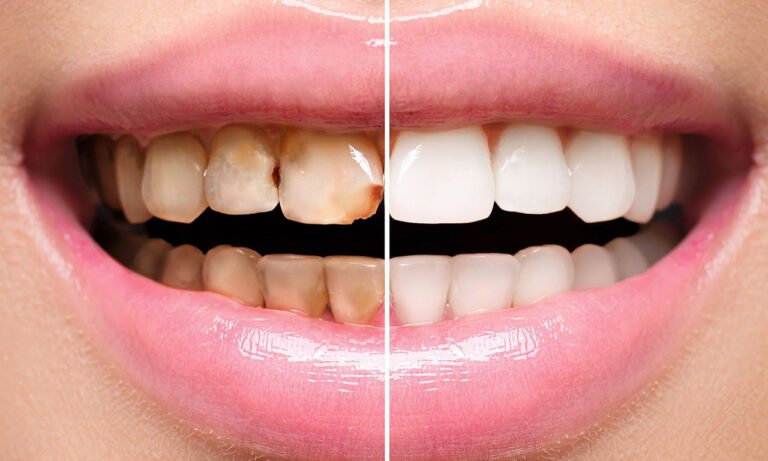 Read more about the article Τι δείχνει το χρώμα των δοντιών για την υγεία σας