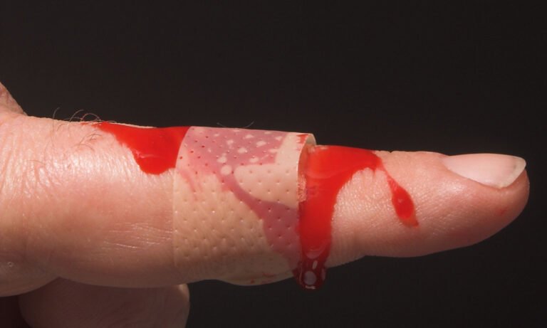 Read more about the article Αιμορραγία: 5 απλοί τρόποι για να τη σταματήσετε