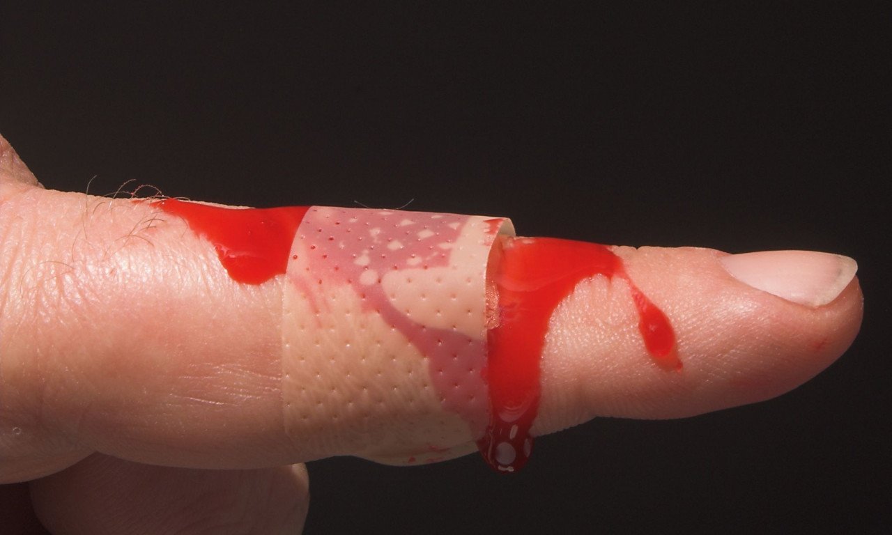 You are currently viewing Αιμορραγία: 5 απλοί τρόποι για να τη σταματήσετε