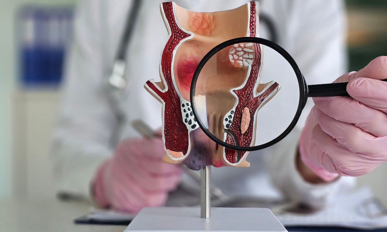 You are currently viewing Καρκίνος του Ορθού – Ενδεδειγμένες Θεραπευτικές Επιλογές