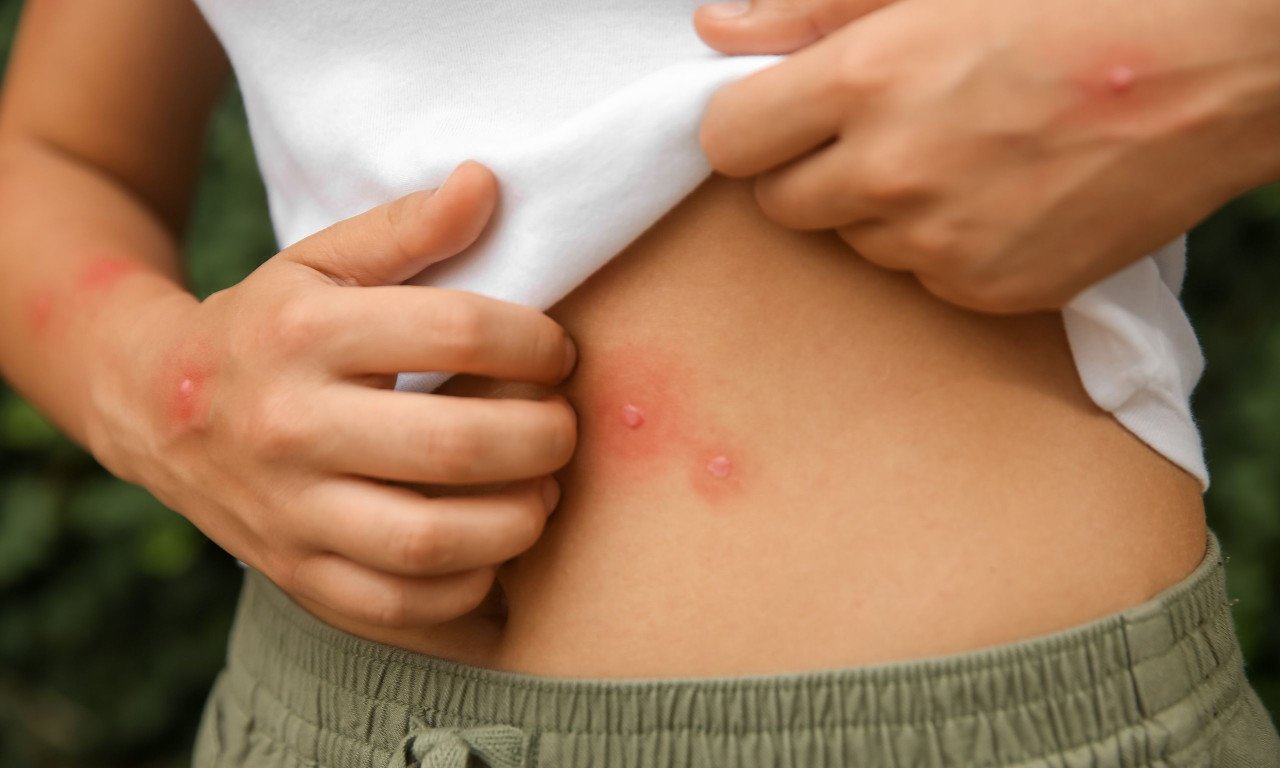 You are currently viewing Τι δείχνει αν βγάλετε έκζεμα στο στομάχι – Τι να προσέχετε