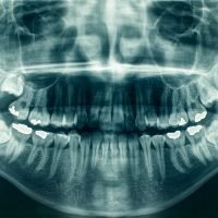 panoramic-dental-x-ray-2026-01-07-23-09-36-utc (1)