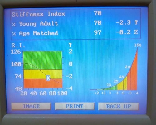 Μέτρηση οστικής πυκνότητας κατ' οίκον