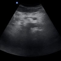 υπέρηχος άνω κοιλίας κατ' οίκον